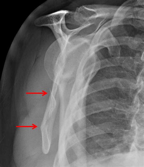Lateral Scapula X Ray