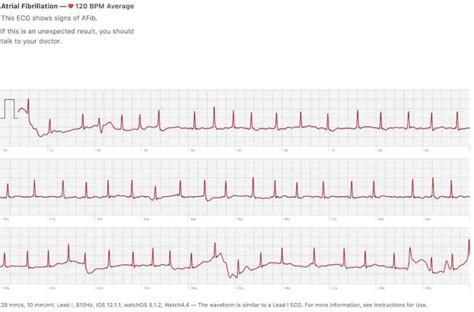 An Apple Watch Told A 46 Year Old Man He Had An Irregular Heartbeat It