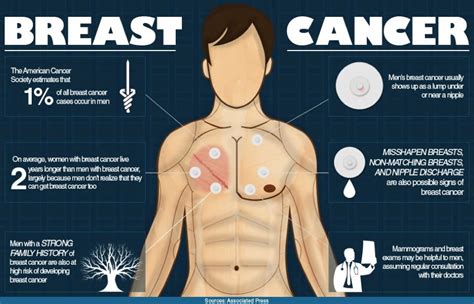 Home remedies for breast lumps. Male Breast Cancer Symptoms, Causes, Types and Diagnosis ...