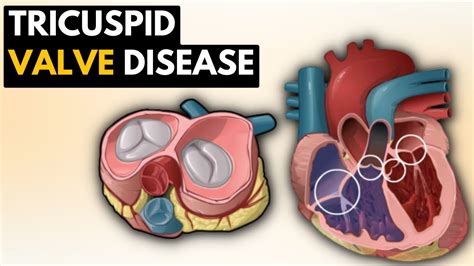 Tricuspid Valve Disease Causes Signs And Symptoms Diagnosis And