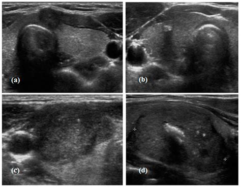 JCM Free Full Text Calcification Patterns In Papillary Thyroid