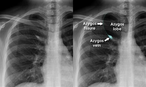 Chest X Ray Anatomical Variants Azygos Fissure
