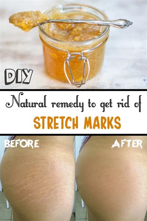Health And Beauty Natural Remedy To Get Rid Of Stretch Marks