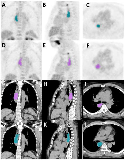 Cancers Free Full Text Can 18f Fdg Petct Radiomics Features