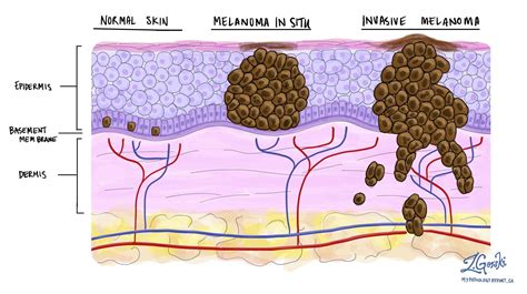 Melanoma In Situ Der Haut Mypathologyreportca