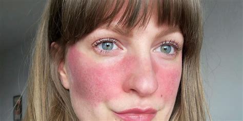 11 People Describe What Its Really Like To Have Rosacea Self