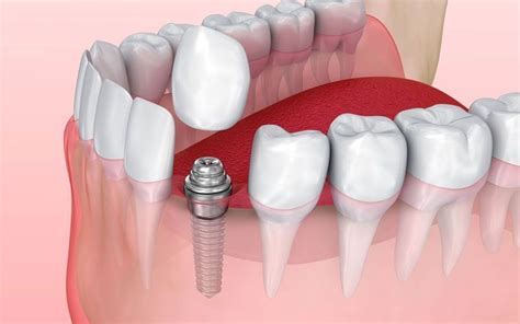 Dental Implants At Best In Karachi Rehan Dental Surgery