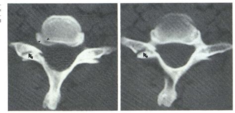 Figure From Uncovertebral And Facet Joint Dislocations In Cervical