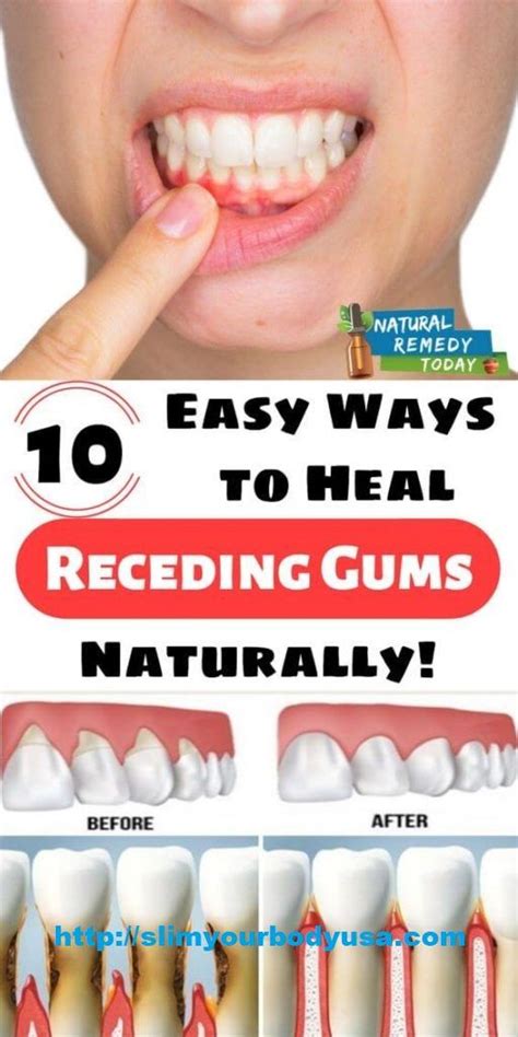 10 Easy Ways To Heal Receding Gums Naturally Gum Recession Can Cause