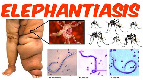 Elephantiasis Youtube