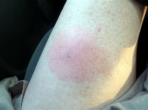Soon, the venom spreads and the injury grows in size, redness, and dead. 16 best Brown Recluse Spider bites images on Pinterest | Brown recluse spider bite, Spider bites ...