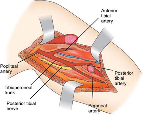 Posterior Tibial Artery Exposure