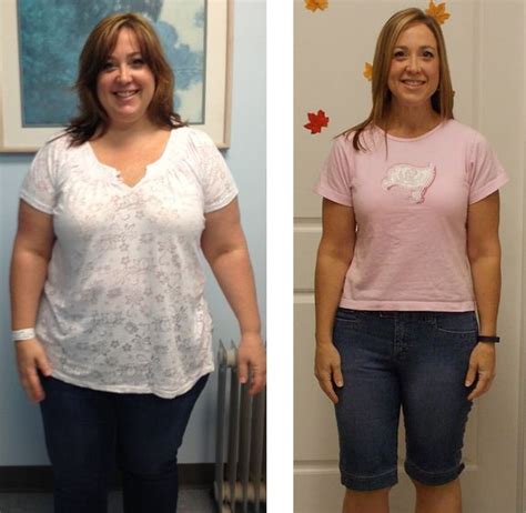 Pin On Bariatric Surgery And Amazing Weightloss