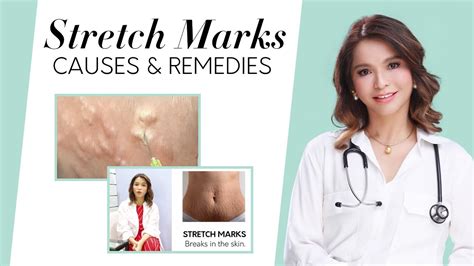 Stretch Marks Causes And Remedies Youtube