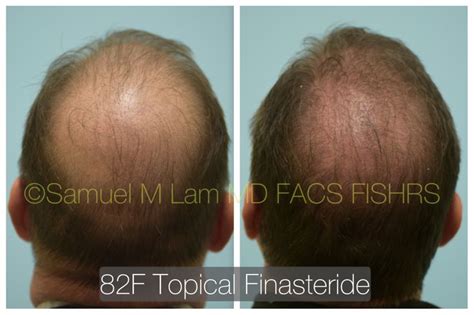 This 49 Year Old Man Is Shown Before And 4 1 2 Months After Starting 82f Topical Finasteride