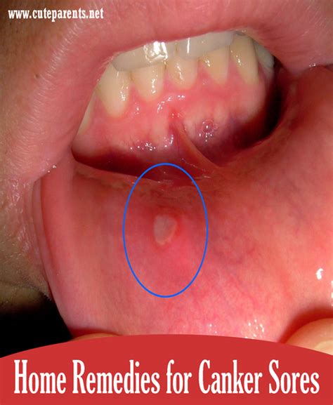 Home Remedies For Canker Sores Mouth Ulcers Ulcer Remedies Mouth
