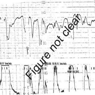 Begin at start of uterine contraction and end with conclusion of contraction (mirror image) 1.2. Reactive CTG with normal baseline heart rate (110-160 bpm ...