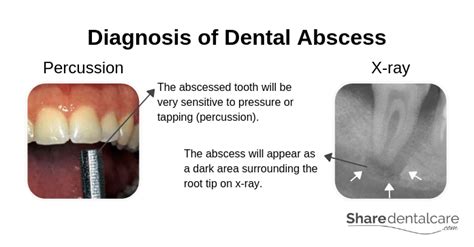 Types Of Dental Abscess Hot Sex Picture