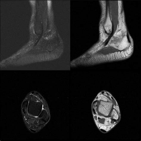 Mri Of Torn Tendon In Left Ankle