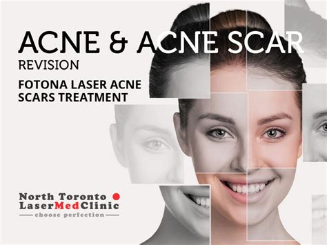 Fotona Laser Treatment For Vaginal Rejuvenation North Toronto Laser