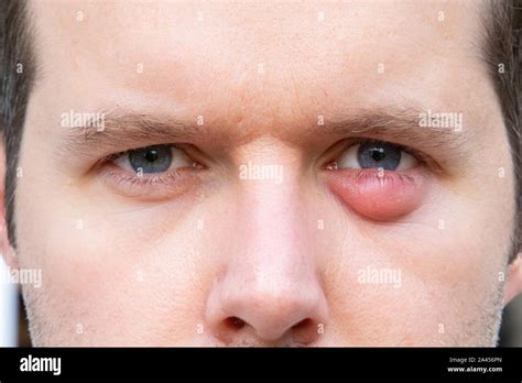 A Man With A Swollen Eyelid Due To An Infection Stock Photo Alamy