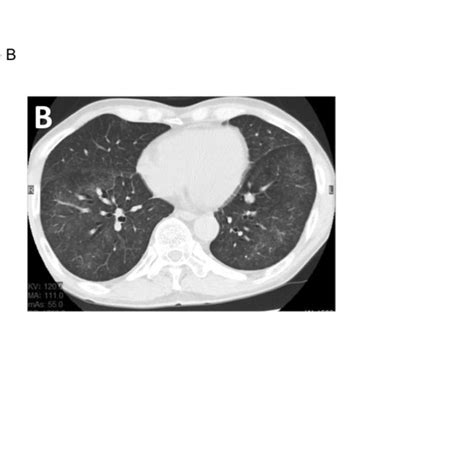 Ct Scan Of The Chest Revealed Nonspecific Reticulonodular Infiltrates