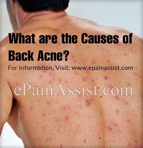 What Are The Causes Of Back Acne And What Is Its Solution