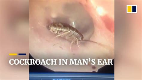 cockroach in man s ear youtube