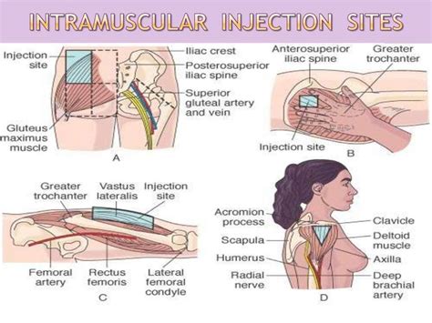MedicTests Com On Twitter Quick Reference Intramuscular Injection Sites A Dorsogluteal B