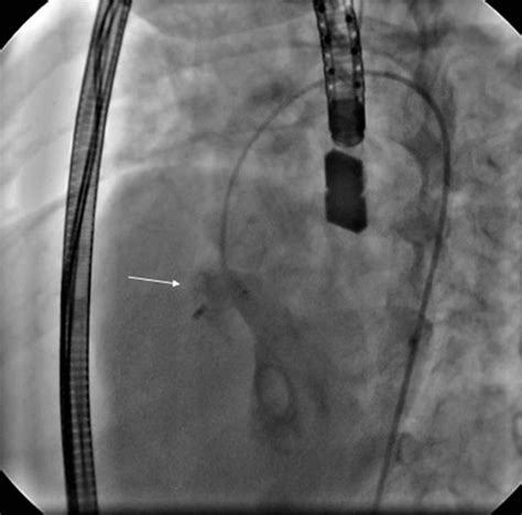 Safety And Efficacy Of Amplatzer Duct Occluder For Percutaneous Closure