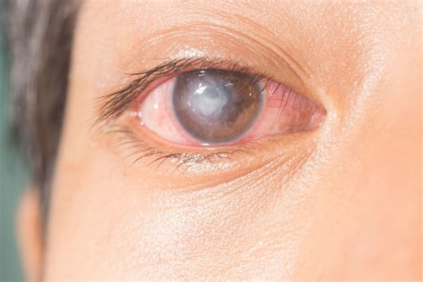 Different Types Of Eye Infections Warning Signs The Eye News
