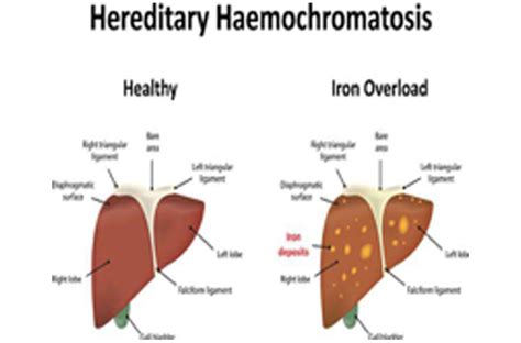Heriditary Hemochromatosis