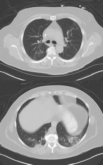 Chest Computed Tomography Of Patient 1 Top Multifocal Centrilobular