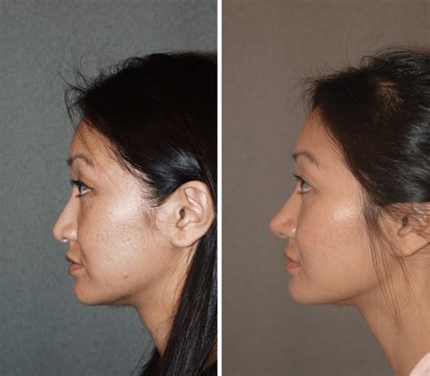Asian Nose Job Before And After