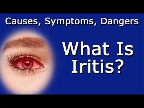 What Is Iritis Causes Symptoms Dangers To Vision Health YouTube