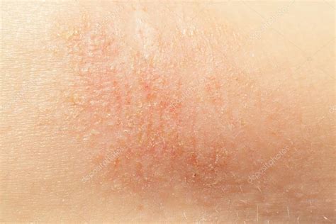 Eczema On Child Skin Stock Photo By ©smithore 13383779