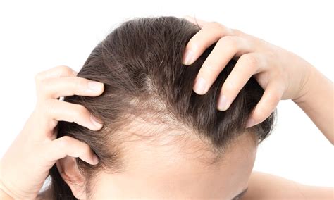 Spotting The Early Signs Of Balding Viviscal Healthy Hair Tips