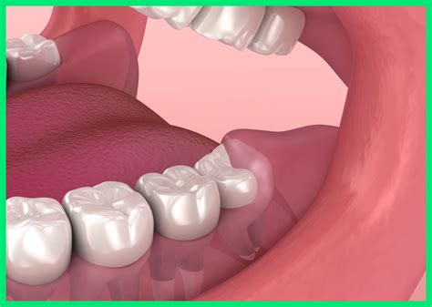 Maybe you would like to learn more about one of these? Wisdom Tooth Extraction - A Better Smile Dental Centre