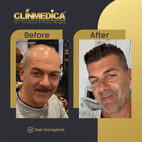Hair Transplant Before And After Results Clinmedica Turkey
