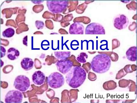 Ppt Leukemia Powerpoint Presentation Free Download Id65553