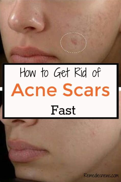Pin On Acne Scars Treatment