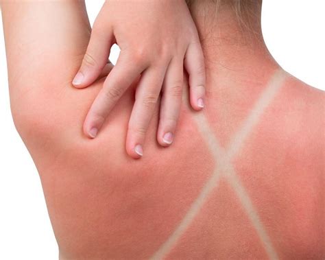 Sunburns How Bad Are They Really Seacoast Dermatology Dermatology