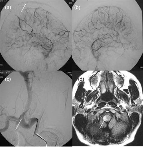 Figure From Cluster Like Headache From Vertebral Artery Dissection Angiographic Evidence Of