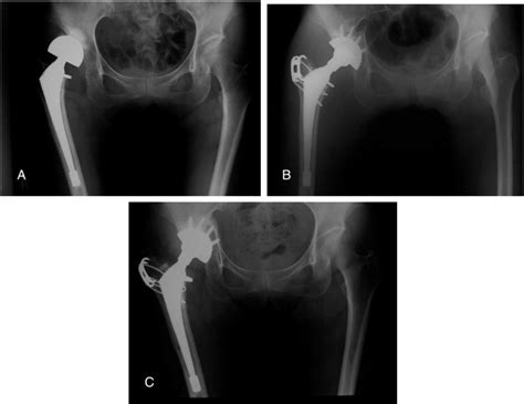 Acetabular Reconstruction With Chiari Pelvic Osteotomy The Journal Of
