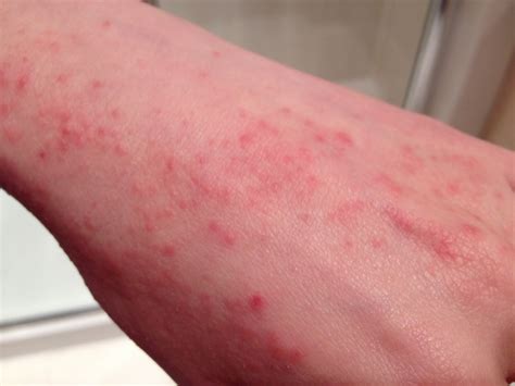 Bumpy Skin On Arms Pictures Photos
