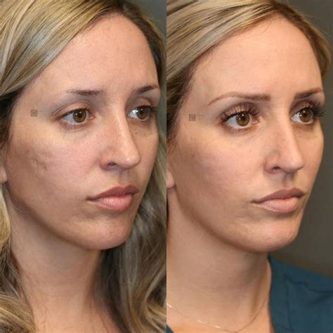Patient 81572639 Photodynamic Acne Scar Remodeling Before And After