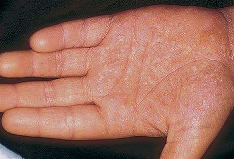 What To Know About Palmoplantar Pustulosis The Dermatology Center Of Indiana