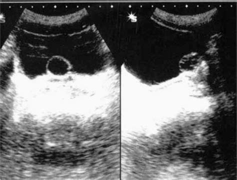 Hypogastric Ultrasound Showing Cystic Lesion In The Prostatic Midline