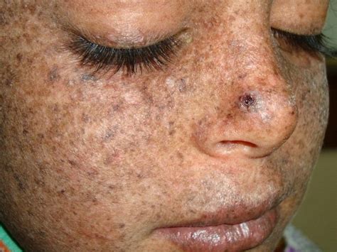 Xeroderma pigmentosum (xp) was first described in 1874 by hebra and kaposi. Xeroderma pigmentosum