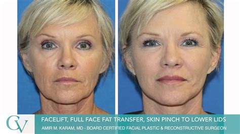 Facelift Surgery San Diego Ca Fat Transfer Skin Pinch To Lower Lids